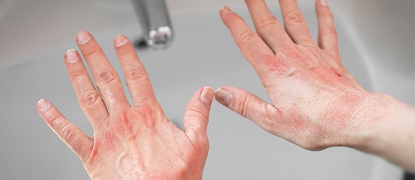Red and itchy hands due to skin dermatitis/eczema​